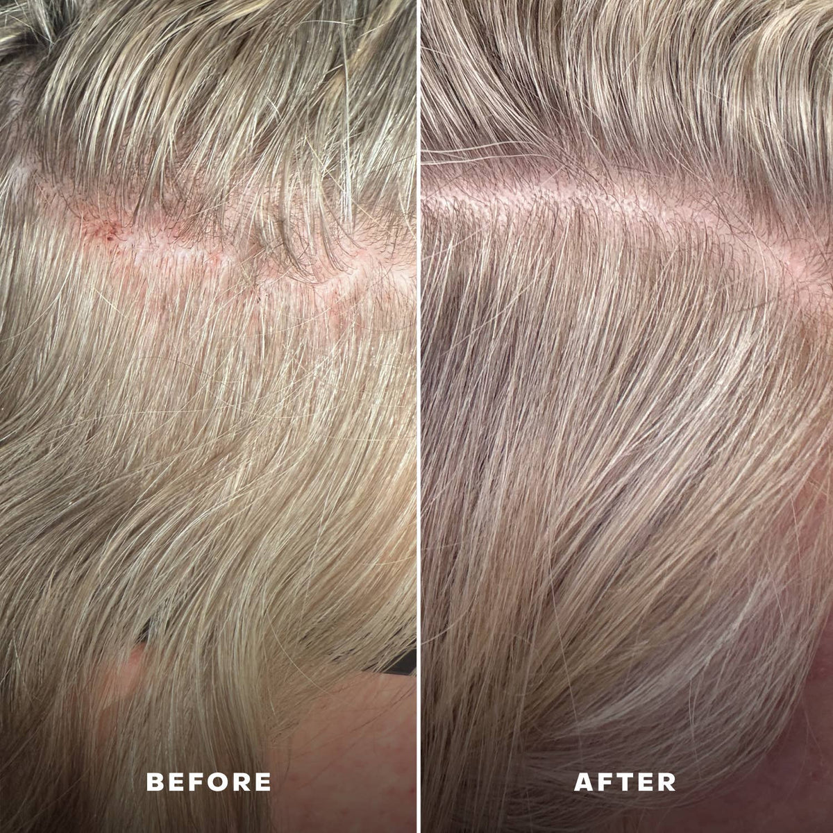 EVERIST Scalp Serum | EverBoost for Dry and Brittle & Thinning Hair