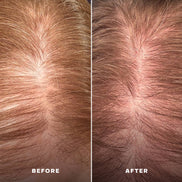 EVERIST Scalp Serum | EverBoost for Dry and Brittle & Thinning Hair